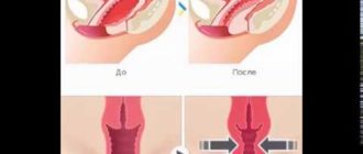 Узкое влагалище