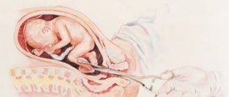 Выкидыши и укрепление матки