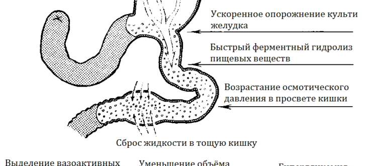 Демпинг- синдром