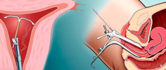 Выпала спираль