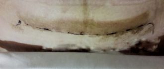 Выделения с запахом после кс