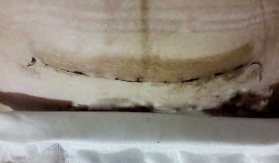 Выделения с запахом после кс