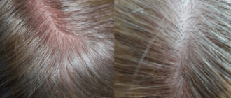 На голове красные пятна и зуд