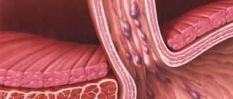 Варикозный узел пищевода