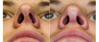 Виноват ли шип носовой перегородки?