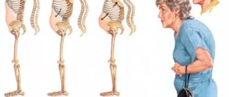 Начальные признаки остеопороза после родов