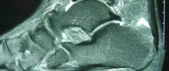 МРТ при ахиллобурсите