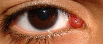 Наросток во внутреннем углу глаза