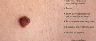 Выпуклая родинка на теле у ребенка