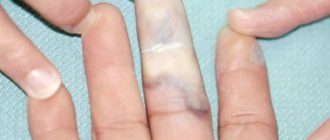 Восстановление фаланги пальца на руке