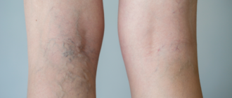 Варикоз и ОК