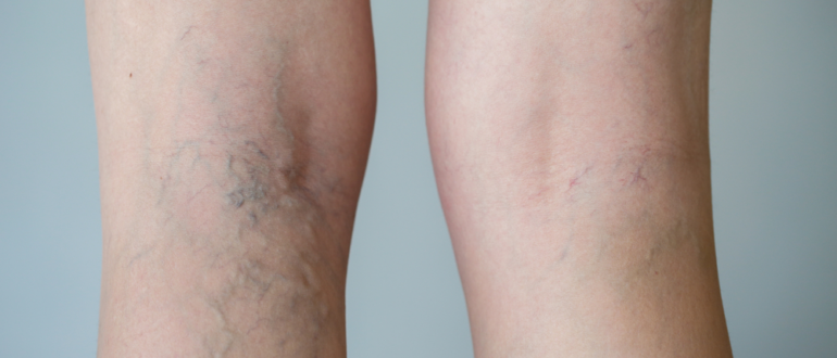 Варикоз и ОК