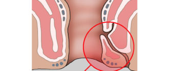Воспаление от ануса до мошонки