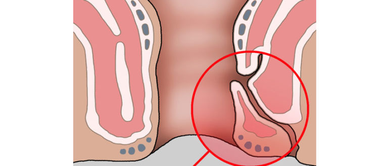 Воспаление от ануса до мошонки