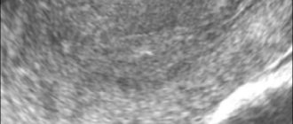 Эндометрия, полость матки контур неровный