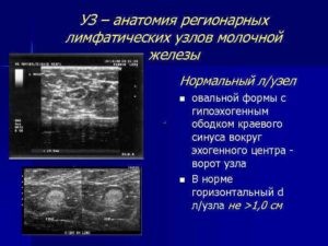 УЗИ молочных желез. Региональный лимфоотток: единичные измененной эхоструктуры