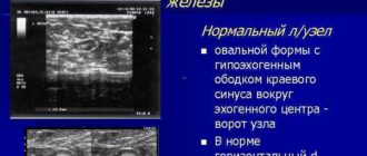 УЗИ молочных желез. Региональный лимфоотток: единичные измененной эхоструктуры