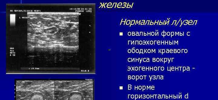 УЗИ молочных желез. Региональный лимфоотток: единичные измененной эхоструктуры