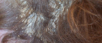 Мокнет голова после окрашивания