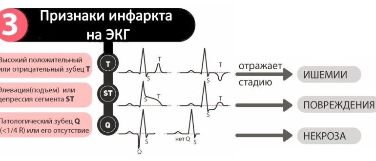 ЭКГ аномальное