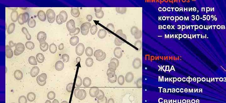 Эритроцитоз + микроцитоз - в чем причина?