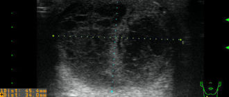Узи щитовидной железы узел форм пирующий