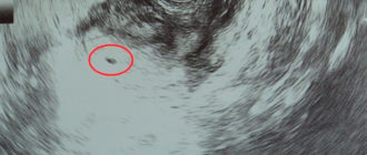 Узи после зачатия