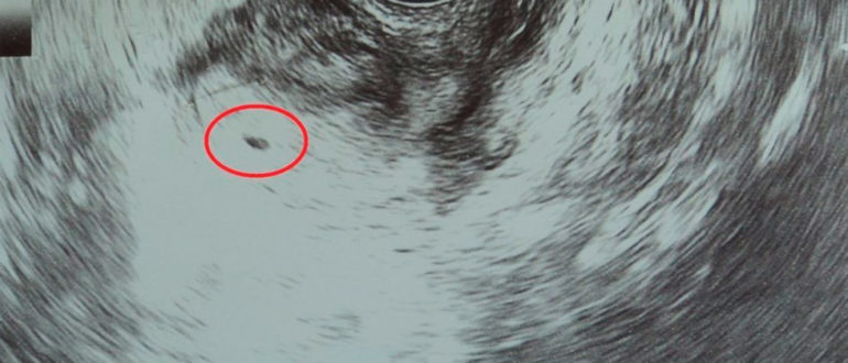 Узи после зачатия