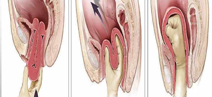 Что-то выходит из влагалища после родов