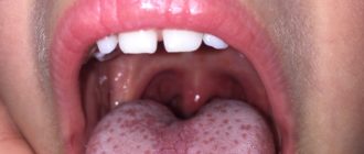 Налет на языке. Белые пятна в горле