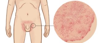 Чешется мошонка