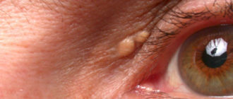 Нарост на веке в уголке глаза