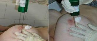 Множественные фиброаденомы, нужна ли пункция?