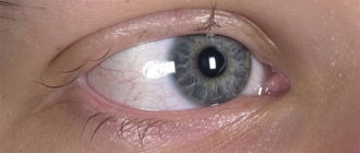 Выпадают ресницы и болит глаз