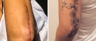 Что то похожее на шрамы