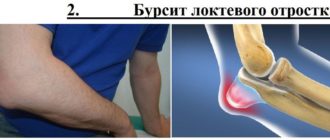 Экзостоз локтевого отростка и бурсит