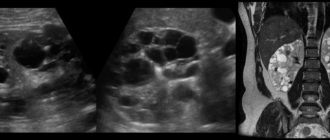 Множественные кисты почек