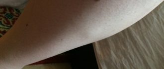 На икрах шишки