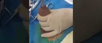 Можно ли обработать зеленку писюн после обрезания