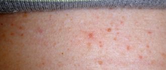 Много маленьких красноватых точек на коже