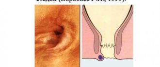 Выпадение геморроидального узла после секса/спорта?