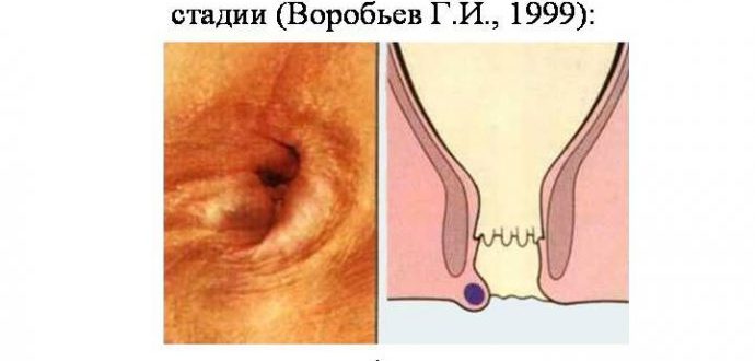 Выпадение геморроидального узла после секса/спорта?