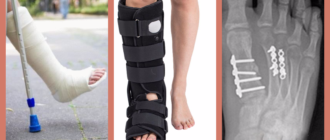 Можно ли наступать на пятку при переломе плюсневой кости