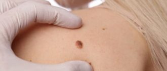 Что-то похожее на родинку