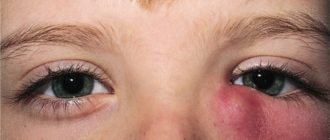 Дакриоцистит проявление