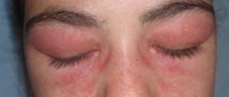 Вокруг глаз отек и покраснение