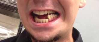 Двойной перелом челюсти со смещением