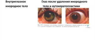 Длительность лечения после удаления инородного тела с роговицы