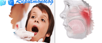 Что принимать при кашле если аденоиды 1-2 ст