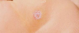 Мозоль или Бородавка